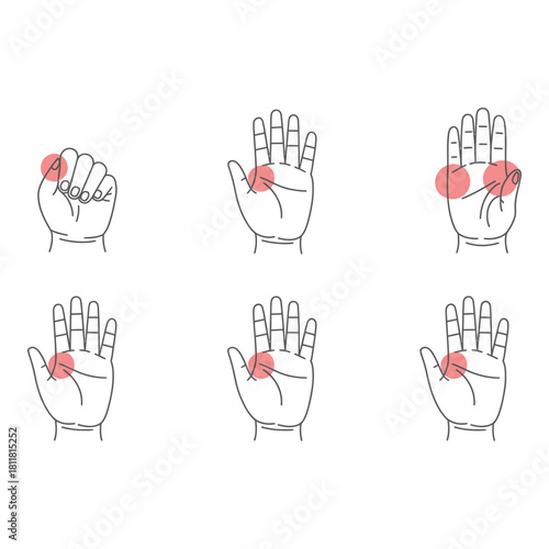 Medical illustration of hand pain points in various positions