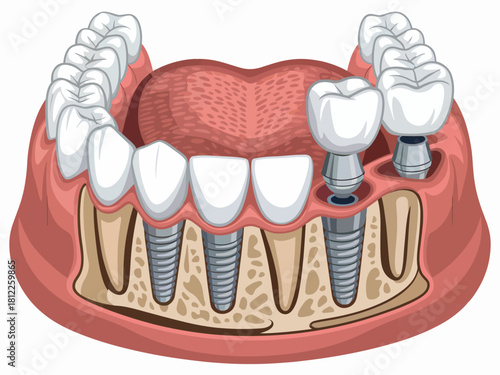 Dental Implant Illustration Depicting Jaw Bone Structure and Teeth Placement for Dentistry Education and Oral Health Awareness in a Diagrammatic Representation