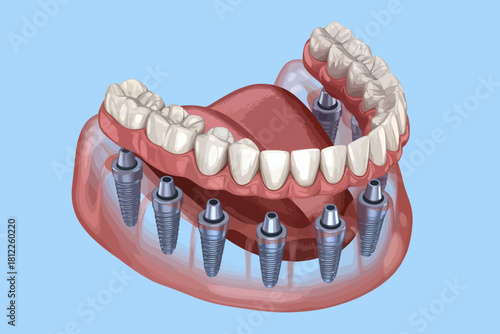 Full set of dental implants illustration for dentistry or medical use featuring the tongue teeth and gums in detail for informative visual content
