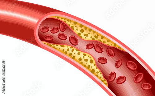 Illustration of Atherosclerosis showing Plaque Buildup in Artery Causing Blood Flow Restriction and Red Blood Cells Passing Through Narrow Vessel