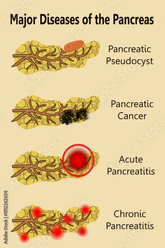 Major Diseases of the Pancreas, early signs of pancreatic cancer