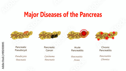 Major Diseases of the Pancreas, diagram with Latin names