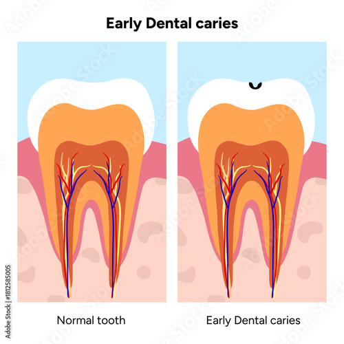 Hand-drawn dental infographic illustrating tooth anatomy and stages of cavity development. Educational medical illustration showing enamel, dentin, pulp, plaque, and decay progression