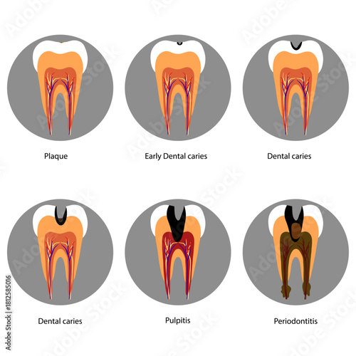 Hand-drawn dental infographic illustrating tooth anatomy and stages of cavity development. Educational medical illustration showing enamel, dentin, pulp, plaque, and decay progression