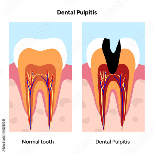 Hand-drawn dental infographic illustrating dental pulpitis within tooth anatomy. Enamel, dentin, pulp chamber, nerve inflammation, and affected root canal areas