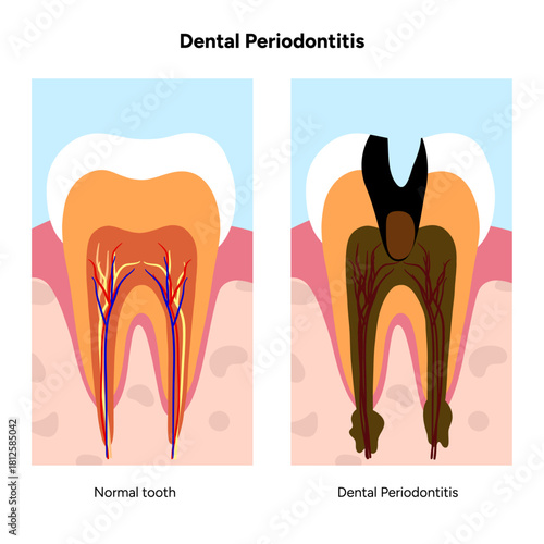 Hand-drawn dental infographic illustrating periodontitis. Inflammation, periodontal ligaments, bone loss, plaque, tartar buildup, and affected tooth anatomy layers