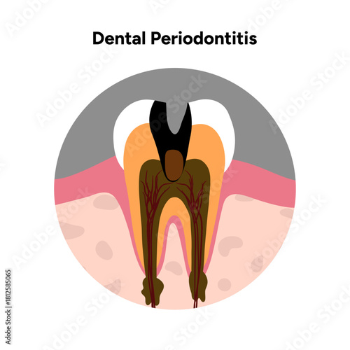 Hand-drawn dental infographic illustrating periodontitis. Inflammation, periodontal ligaments, bone loss, plaque, tartar buildup, and affected tooth anatomy layers