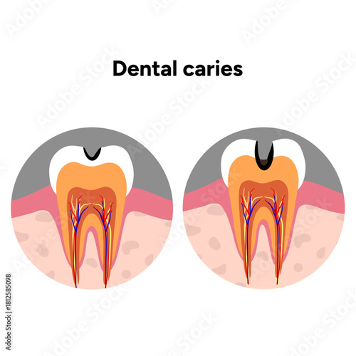 Hand-drawn dental infographic illustrating tooth anatomy and stages of cavity development. Educational medical illustration showing enamel, dentin, pulp, plaque, and decay progression