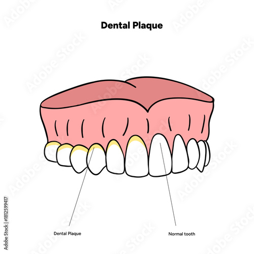 Hand-drawn dental infographic illustrating the formation of dental plaque on tooth anatomy. Includes enamel, dentin, pulp, gum line, and bacterial buildup area