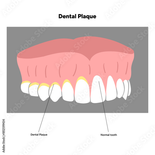 Hand-drawn dental infographic illustrating the formation of dental plaque on tooth anatomy. Includes enamel, dentin, pulp, gum line, and bacterial buildup area