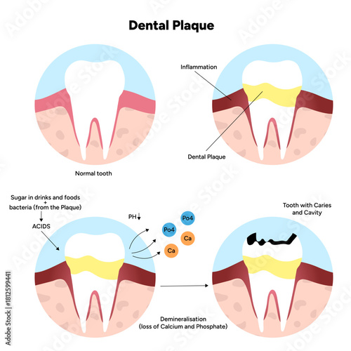 Hand-drawn dental infographic illustrating the formation of dental plaque on tooth anatomy. Includes enamel, dentin, pulp, gum line, and bacterial buildup area