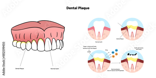 Hand-drawn dental infographic illustrating the formation of dental plaque on tooth anatomy. Includes enamel, dentin, pulp, gum line, and bacterial buildup area