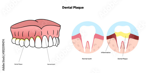 Hand-drawn dental infographic illustrating the formation of dental plaque on tooth anatomy. Includes enamel, dentin, pulp, gum line, and bacterial buildup area