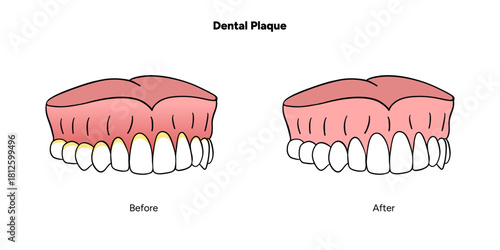 Hand-drawn dental infographic illustrating the formation of dental plaque on tooth anatomy. Includes enamel, dentin, pulp, gum line, and bacterial buildup area