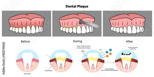 Hand-drawn dental infographic illustrating the formation of dental plaque on tooth anatomy. Includes enamel, dentin, pulp, gum line, and bacterial buildup area