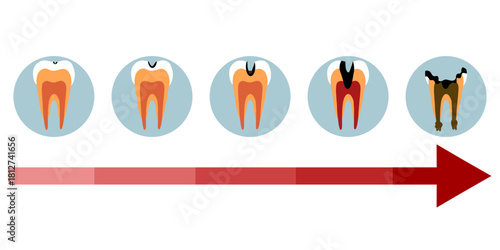 Hand-drawn dental infographic illustrating tooth anatomy and stages of cavity development. Educational medical illustration showing enamel, dentin, pulp, plaque, and decay progression
