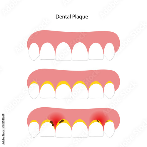 Hand-drawn dental infographic illustrating the formation of dental plaque on tooth anatomy. Includes enamel, dentin, pulp, gum line, and bacterial buildup area