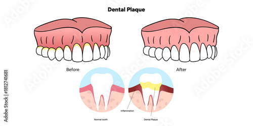 Hand-drawn dental infographic illustrating the formation of dental plaque on tooth anatomy. Includes enamel, dentin, pulp, gum line, and bacterial buildup area