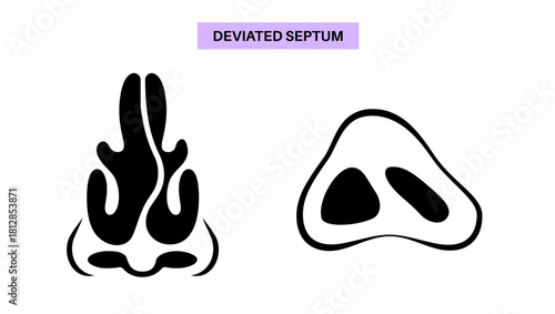 Deviated septum poster