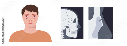 Nasal fracture poster