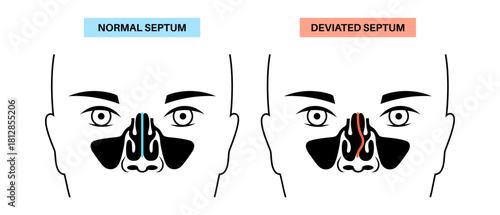 Deviated septum poster
