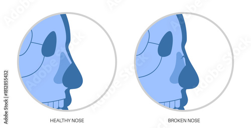Nasal fracture poster