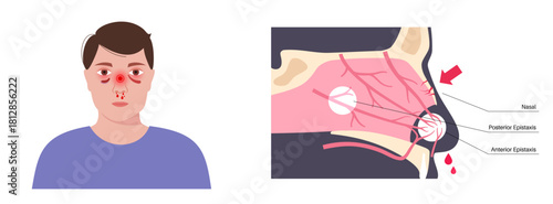 Nasal fracture poster