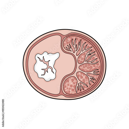 Cross section of an aorta with atherosclerosis plaque and healthy arterial wall detail
