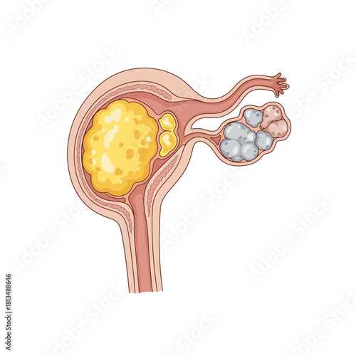 Detailed illustration of female reproductive system showing uterine fibroids and polycystic ovary