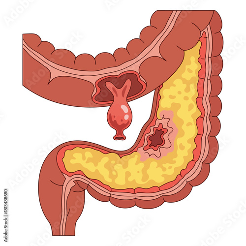 Diagram of Diverticulitis and Colon Inflammation Showing Ulcers and Sacs