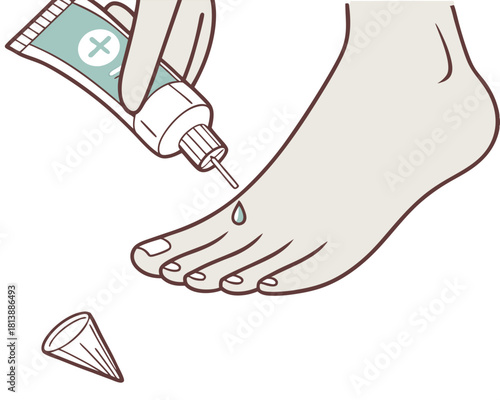 Illustration of a foot being treated with ointment dropping onto the toe on a white background