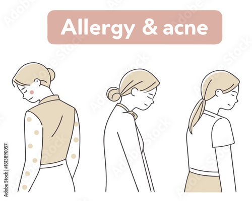 Medical illustration depicting allergic reactions and acne manifestations on a young female against white