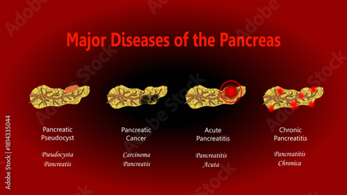 Major Diseases of the Pancreas, diagram with Latin names