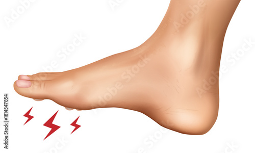 A realistic medical illustration of a human foot showing pain in the forefoot area, representing clavus disease or corn. Clavus Disease on Foot