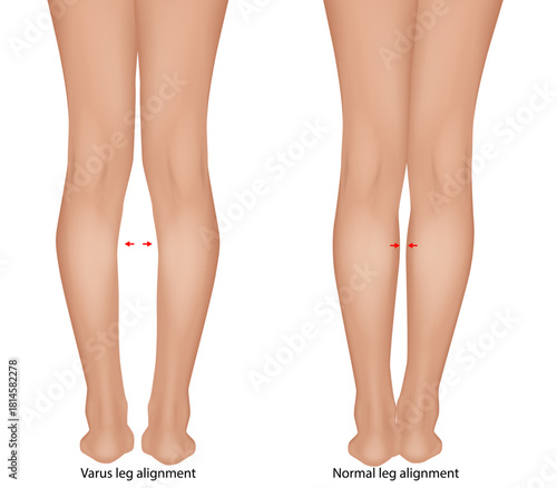 Detailed medical illustration comparing varus leg alignment  with normal leg alignment. Genu Varum Comparison with Normal Lower Limb Anatomy