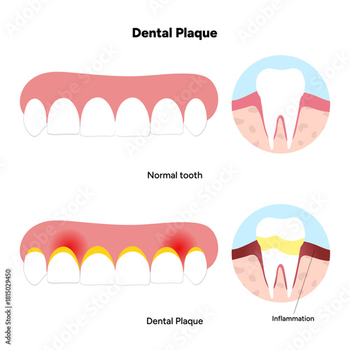 Hand-drawn dental infographic illustrating the formation of dental plaque on tooth anatomy. Includes enamel, dentin, pulp, gum line, and bacterial buildup area