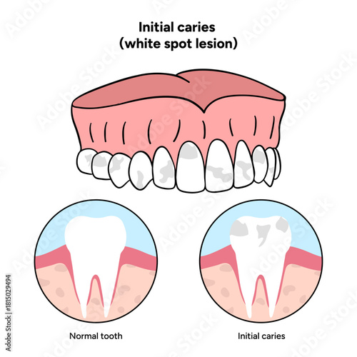 Hand-drawn dental infographic illustrating initial caries white spot lesion. Shows enamel demineralization, tooth layers, enamel surface changes, and early-stage decay. 