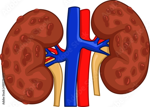 illustration of the anatomy of a sick or damaged human kidney