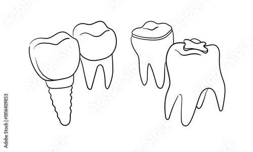 4 Teeth set continious line drawing. Dentistry, caries, filling, implant outline. Vector illustration. 