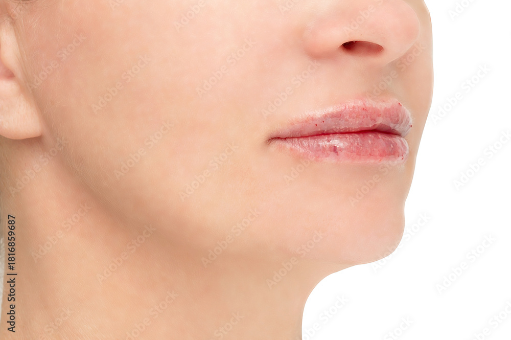 Obraz premium A woman's face with injection marks and bruises after a lip augmentation procedure.