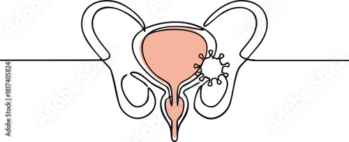 Line art of pelvis with a bladder and prostate, and virus or bacteria, indicating infection presents Pelvic infection with prostate and bladder, highlighting viral presence,