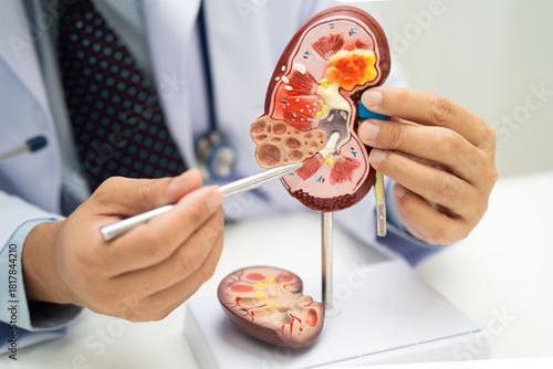 Konstfotografi Kidney disease, Chronic kidney disease ckd, Doctor hold human model to treat and study in hospital