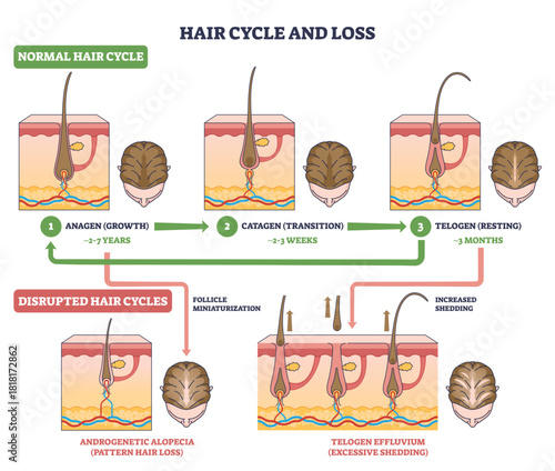 Hair cycle and loss visual explains anagen, catagen, telogen and how disruption causes shedding, key objects, follicles, scalp sections, arrows. Outline diagram