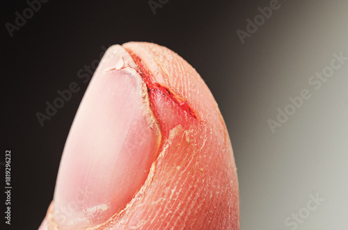Fotografie Close-up of a cut on a finger with blood, showing injury and pain