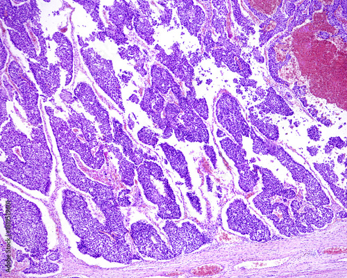 Urinary bladder. Transitional cell carcinoma