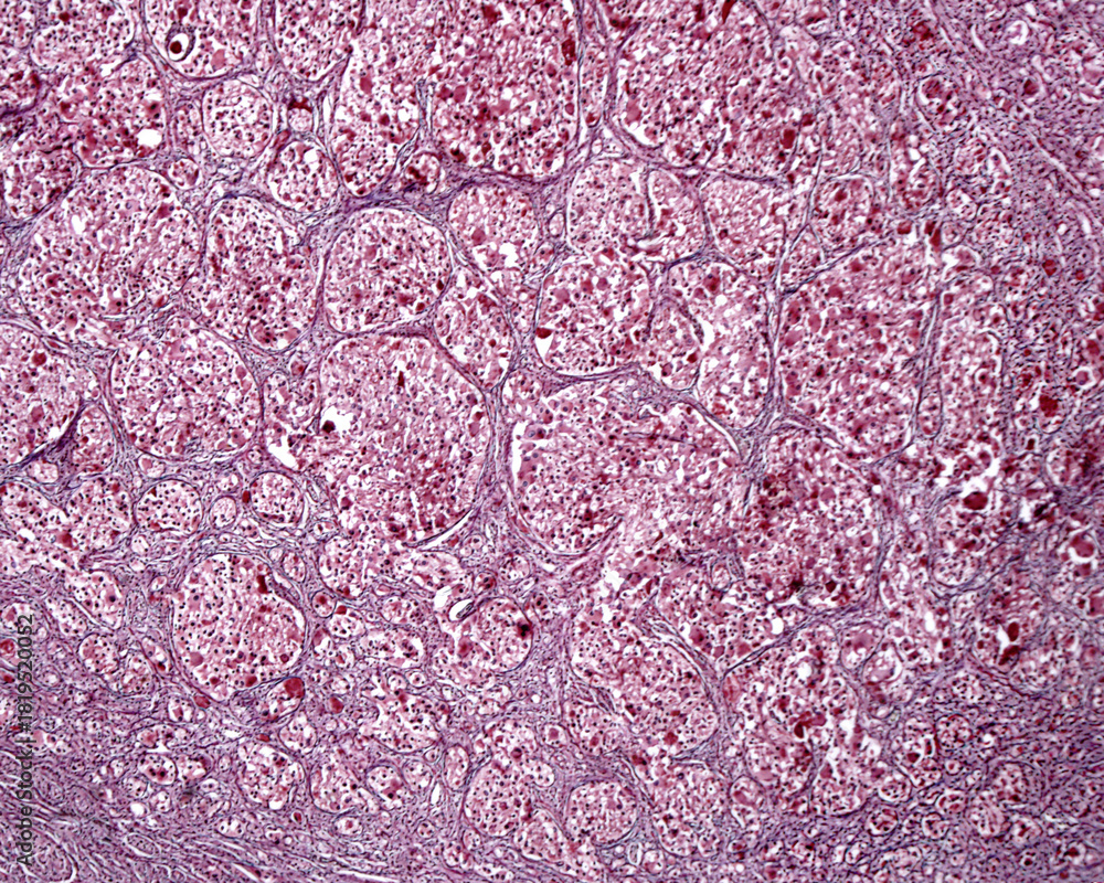 Obraz premium Superior cervical ganglion. Ganglioneuroma