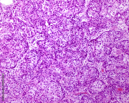 Urinary bladder. Transitional cell carcinoma