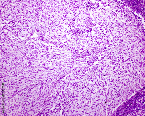 Melanoma. Human lymph node metastasis