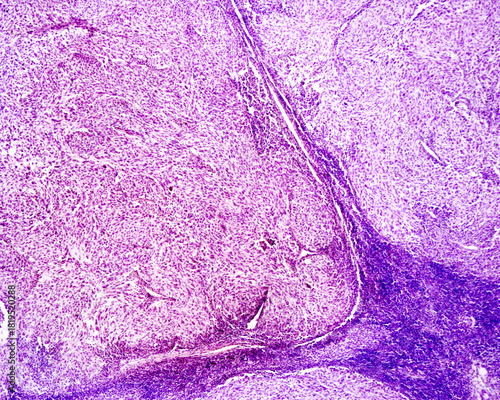 Melanoma. Human lymph node metastasis