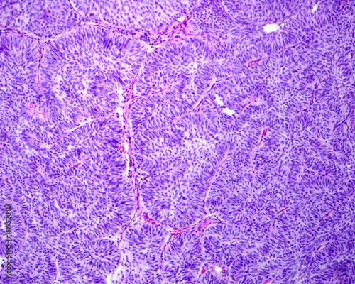 Human urinary bladder papilloma